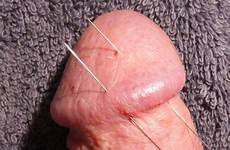 cbt needles acupuncture thisvid rating