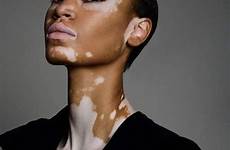 vitiligo skin causes cures sempurna buktikan wanita cantik tak terpopuler diversity