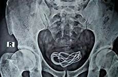 penis bladder inserted cnn kabel kemih pria kantung mans ditemukan kandung cabo shocked pene inserting kok celular uretra swallowed sounding