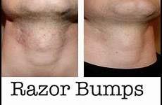 razor bumps treatments ingrown shaving armpit instiks scalp