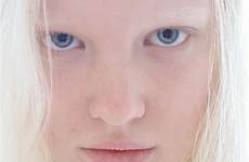 white albino woman pale girl linn hair swedish skin models newfaces platinum classify blonde young cute article albinism natural women