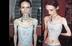 disorders eating nervosa bulimia anorexics