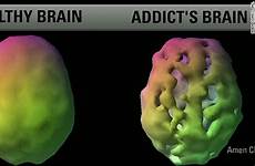 scans amen spect addict addition depression shrink erin intv exp