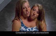 twins teachers conjoined viral alltop hensel also