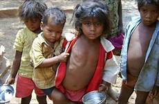 malnutrition malnourished rescued operation pari singh shamed representational