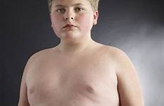 fat children weight obese kid child surgery part obesity outrage numbers loss useful needing getty patient flabby