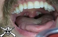disgusting disease throat