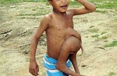 boy legs child limbs india unique indian born parasitic twin children god real boys body eight has twins limbed who