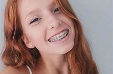 freckles redheads braces stunningly