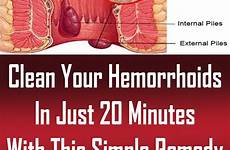 hemorrhoids hemroid remedy parasites swelling