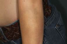 forearm unexplained bruising teenage female painful