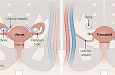 uterus pregnancy pregnant women transplants some lactation become science