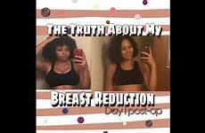 reduction breast
