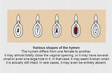 hymen look does different why yx myths