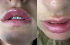 surgery tina cosmetic lips swollen boom safe copyright