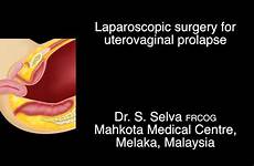 prolapse surgery laparoscopic
