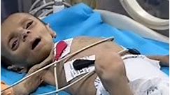 Malnourished child in Gaza