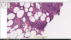 Lupus panniculitis (lupus profundus)