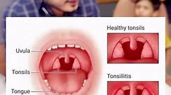 Difference between enlarged tonsils and tonsillitis. #drimranpatel | Imran Patel