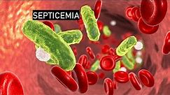 Septicaemia/ Blood poisoning
