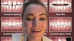 Overbite is up and down. Overjet is forward and back #braces | Levi Carson