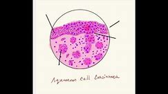 squamous cell carcinoma histology