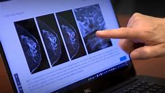 See how AI can predict future cancer risk