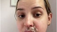 'Winning free fillers in social media giveaway put me in hospital – I almost lost my lip' (part 1)