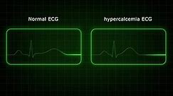 Normal and hypercalcemia Electrocardiogram 3d rendered video clip