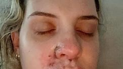 'Winning free fillers in social media giveaway put me in hospital – I almost lost my lip' (Part 2)