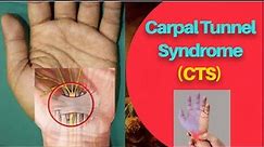 Carpal Tunnel Syndrome (CTS) || Median Nerve Compression || @PhysiotherapyKnowledge