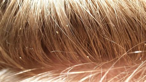 Can Lice Cause Big Bumps at Michael Davidson blog