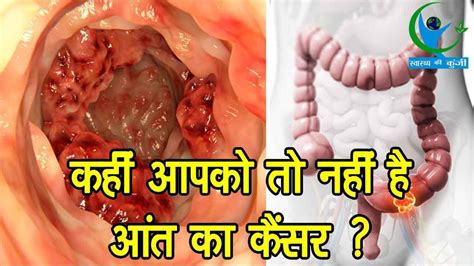 Adenocarcioma is a malignant tumor that may occur in the gastrointestinal (gi) system of a cat. ऐसे करें आंत के कैंसर के लक्षणों की पहचान जाने क्या है ...