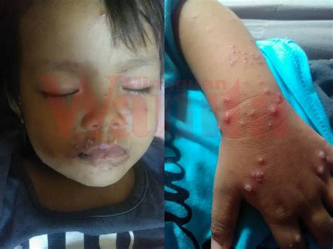 Kalau petua orang lama dulu, menyarankan pesakit chickenpox tidur beralaskan daun semambu. Cara Nak Jaga Anak Kena Chicken Pox, Mak-mak Jangan ...