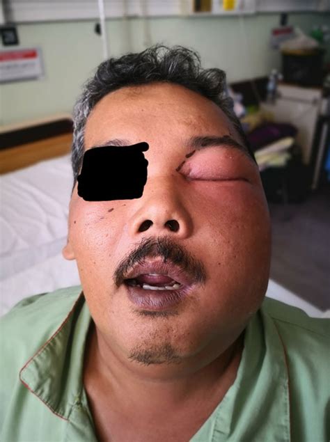 #jangkitan kuman dalam tekak punca anak demam terlalu tinggi sampai pucat bibir anak sebab demam tinggi sangat.cepat2 bawa emergnce. 'Banyak sangat nanah keluar weh!' - Akibat letak minyak ...