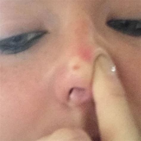 Donors with a history of. Nurse who began using sunbeds aged 13 ends up with coin ...