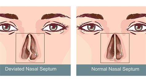 The best way to know if the septum is deviated is to see a rhinoplasty surgeon or ear, nose, and throat specialist for an exam. I Took The Decision To Get My Nose Surgery Done | HEALTH ...