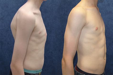 This happens because of an unusual growth of rib and breastbone (sternum). Chest bracing works wonders for teenage pectus carinatum ...