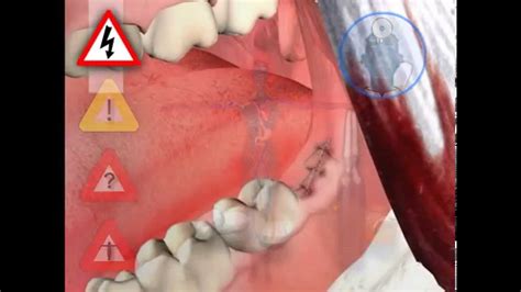 Typically, the cost of wisdom tooth removal ranges from $160 to $500, depending on how severely or minorly impacted your wisdom tooth is. Primary How Much Does It Cost To Get Wisdom Teeth Removed ...