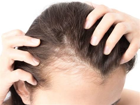 Tight hairstyles that pull the hair at the roots might cause hair loss. Daily Hairstyles For Reducing Reclining Hairline Female ...