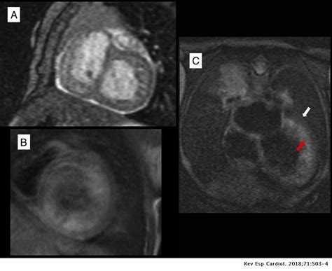 Current trends in diagnosis and treatment. Miocarditis aguda frente a miocardiopatía no compactada en el lactante: utilidad de la ...