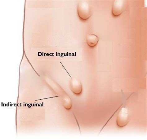 Direct inguinal hernias and femoral hernias had higher risk of reoperation for recurrence after open repair compared with indirect inguinal hernias ( 55 ). Inguinal Hernia - Symptoms, Causes And It's Prevention | Premier Hospital