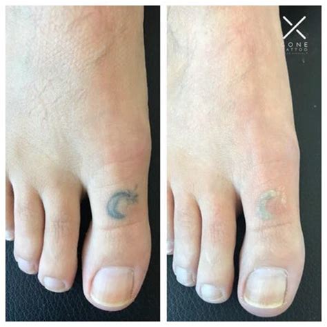 Unwanted tattoos are removed using a procedure called laser tattoo removal (ltr). Pin by Gone Tattoo Laser Removal - Ha on Before and After Tattoo Removal | Tattoo cream, Tattoo ...