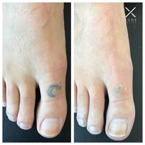 The intent is to remove the layers of the skin that contain the ink particles, thereby removing the tattoo. Pin by Gone Tattoo Laser Removal - Ha on Before and After ...