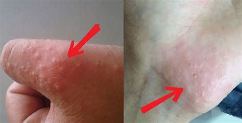 Penyebab Dan Nama Obat Kutu Air Di Kulit Berair Yang Manjur