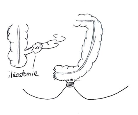 L'un tapisse tous les organes (viscères) contenus dans l'abdomen (péritoine viscéral). Colon : Après la chirurgie | Centre Lyonnais de Chirurgie ...