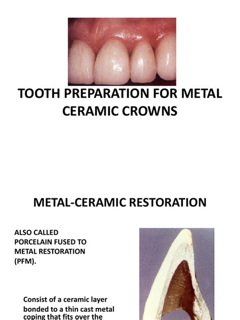 The biggest advantage of the ceramic restoration is its permanent aesthetic quality. 5. Metal Ceramic Restoration | Mouth | Dentistry