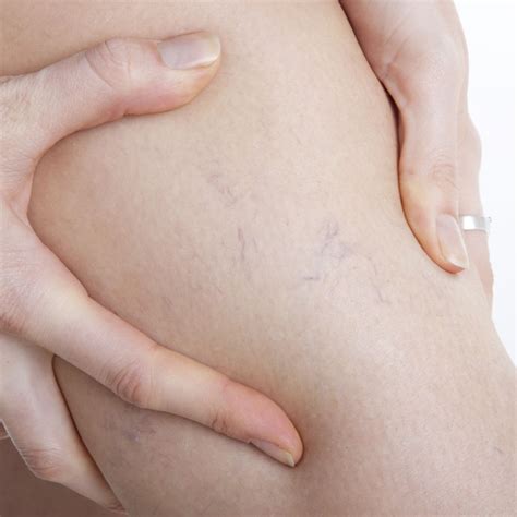 How to buy and prepare zucchini. Why Can I See my Veins? | Healthcare-Online
