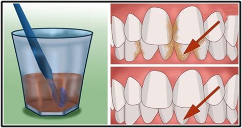 Bila terus dibiarkan, plak akan membentuk karang gigi dan bisa berujung pada munculnya bau mulut, gigi yang lebih sensitif, gigi berlubang, radang gusi, hingga gigi yang tanggal. Dahsyat !!! Inilah Cara Menghilangkan Plak Atau Karang ...