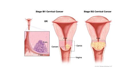 Check spelling or type a new query. Kanker Serviks - Adi Husada Cancer Center (AHCC)